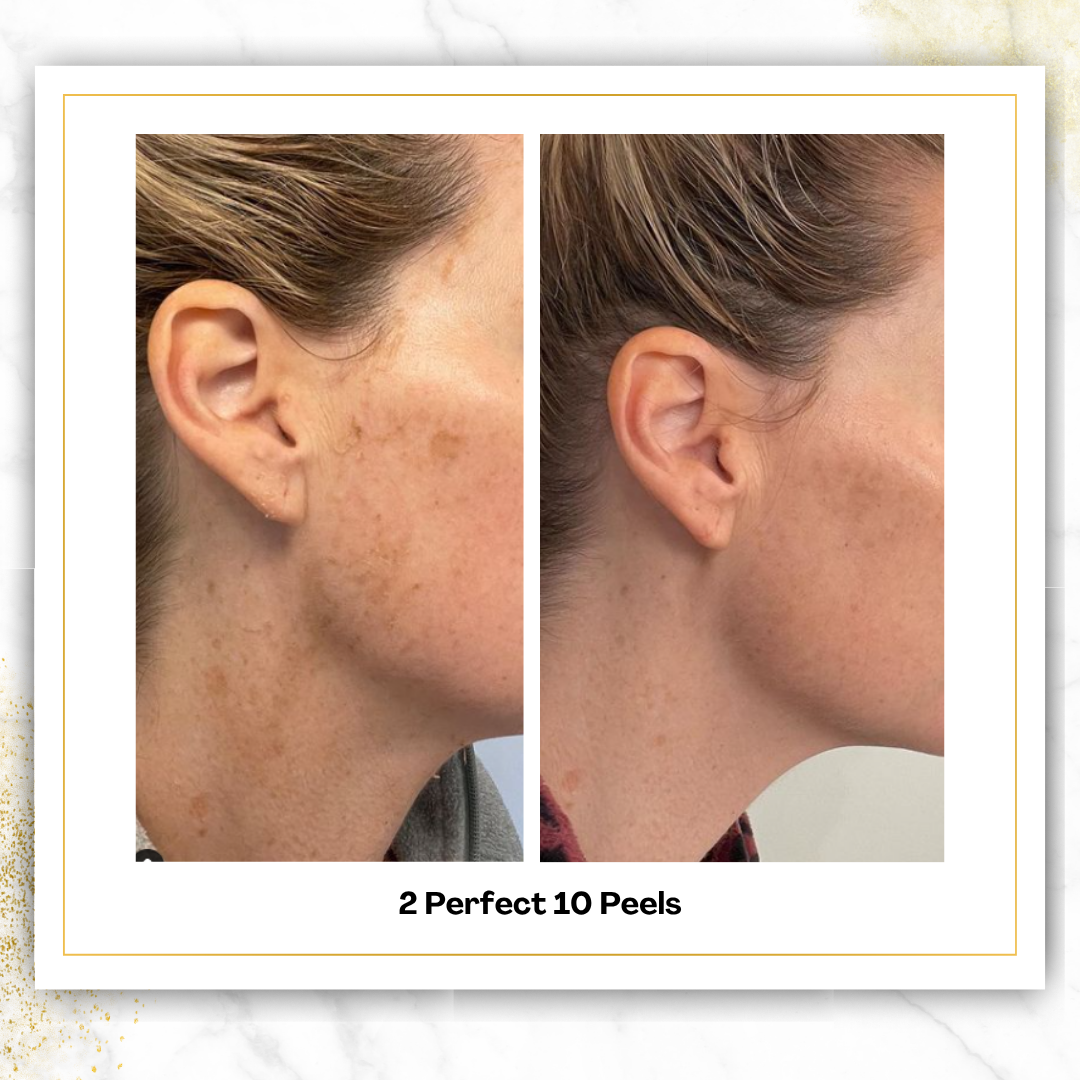 Perfect 10 Peel in San Antonio | $150 | DaVida Aesthetics