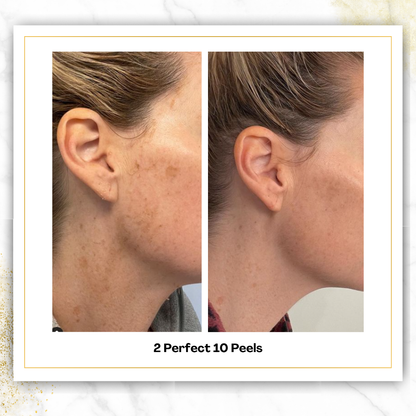 Perfect 10 Peel in San Antonio | $150 | DaVida Aesthetics