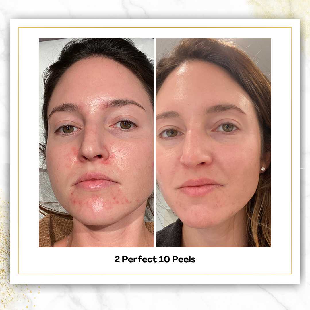 Perfect 10 Peel in San Antonio | $150 | DaVida Aesthetics