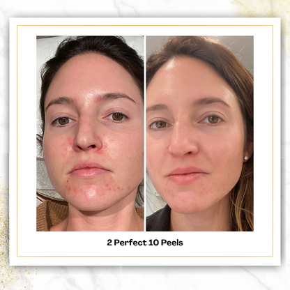 Perfect 10 Peel in San Antonio | $150 | DaVida Aesthetics