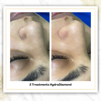 HydroDiamond Facial in San Antonio | From $150 | DaVida