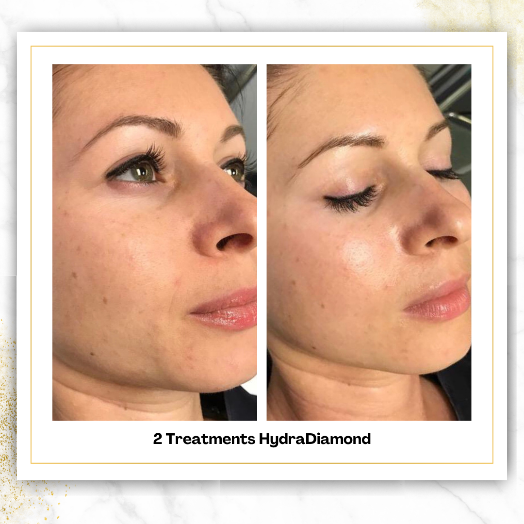 HydroDiamond Facial in San Antonio | From $150 | DaVida