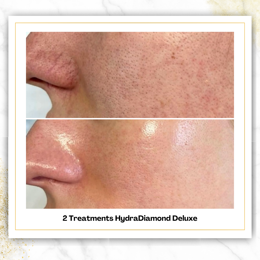 HydroDiamond Facial in San Antonio | From $150 | DaVida