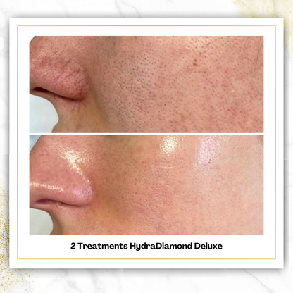HydroDiamond Facial in San Antonio | From $150 | DaVida