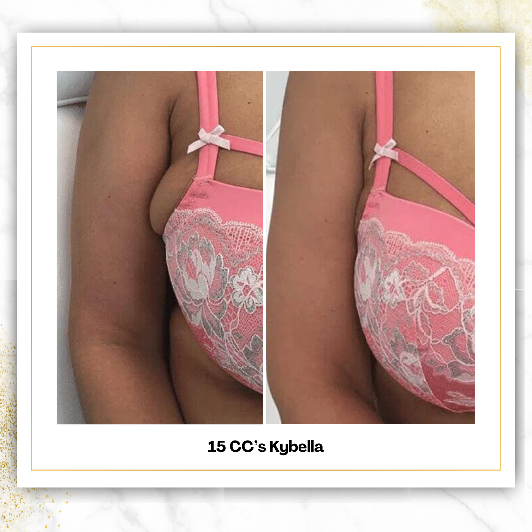 Kybella (Liquid Lipo) | 4 CC Unit Minimum