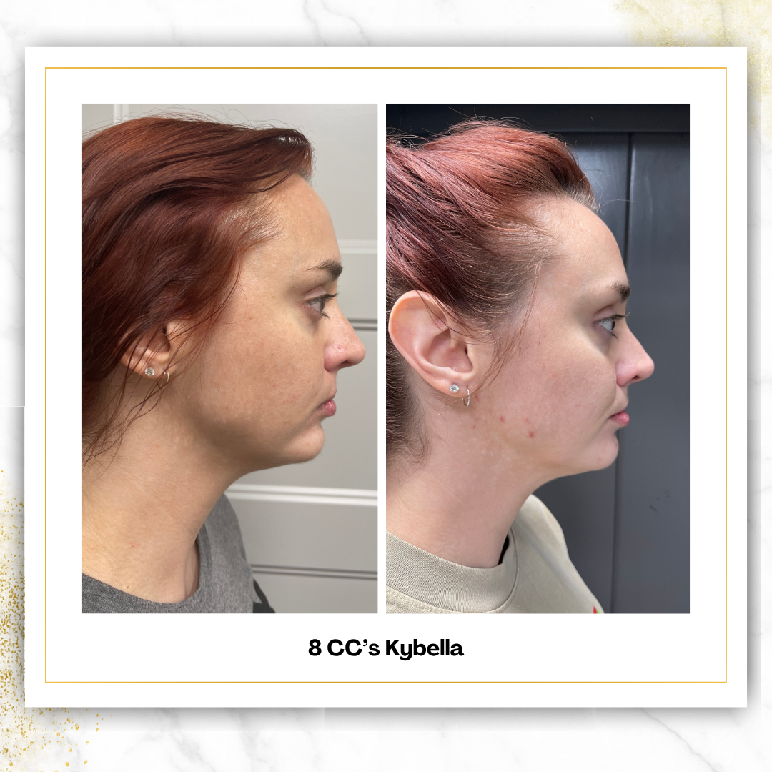 Kybella (Liquid Lipo) | 4 CC Unit Minimum