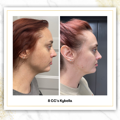 Kybella (Liquid Lipo) | 4 CC Unit Minimum