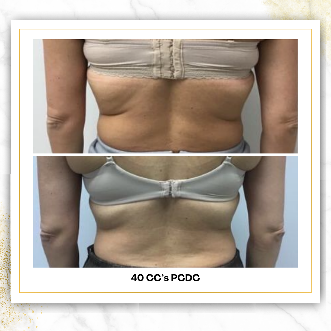 PCDC (Liquid Lipo) | 4 CC Unit Minimum