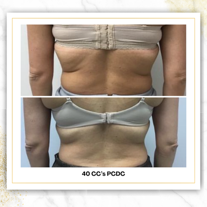 PCDC (Liquid Lipo) | 4 CC Unit Minimum