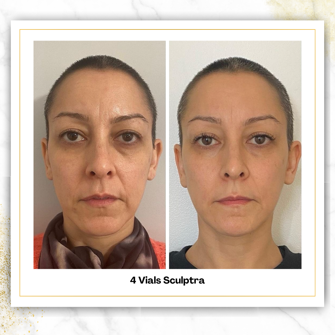 Sculptra