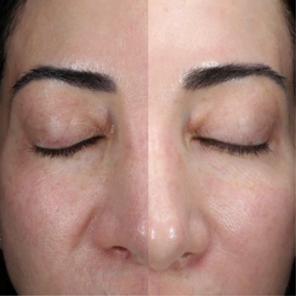 Alastin HA Immerse Hyaluronic Acid Serum