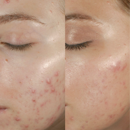 Epionce Lite Lytic Tx | Gentle Exfoliant