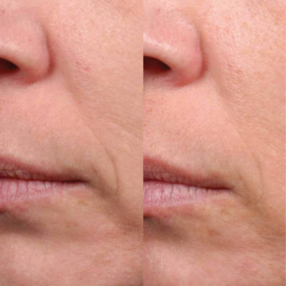 Epionce Lite Lytic Tx | Gentle Exfoliant