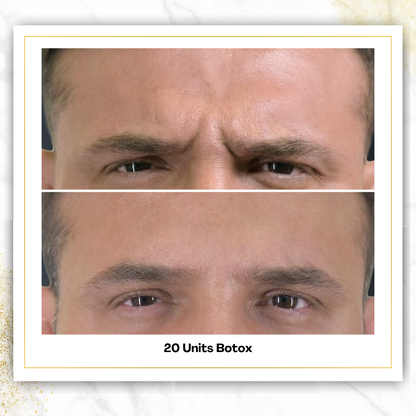 Botox ($6.85/unit)