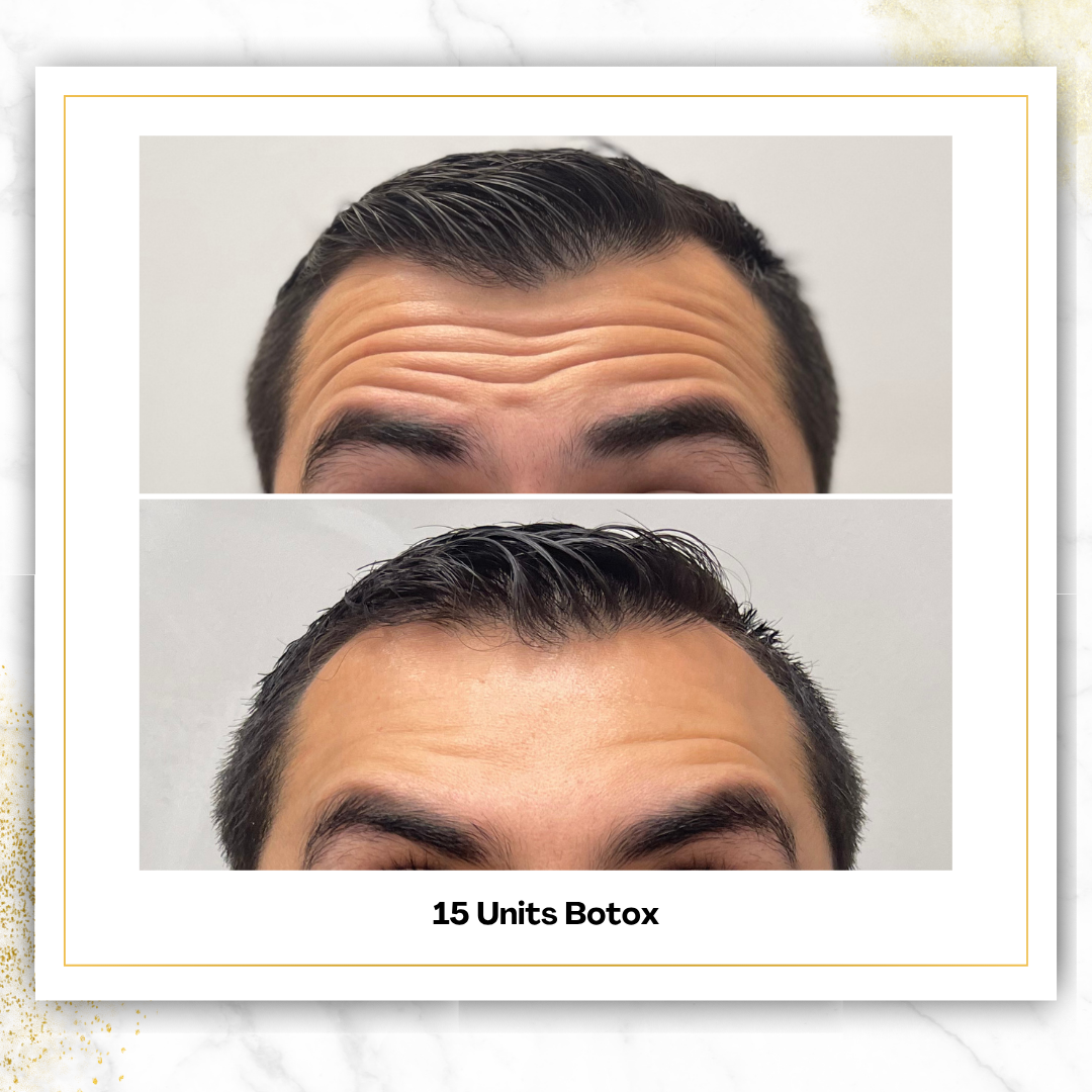 Botox ($6.85/unit)