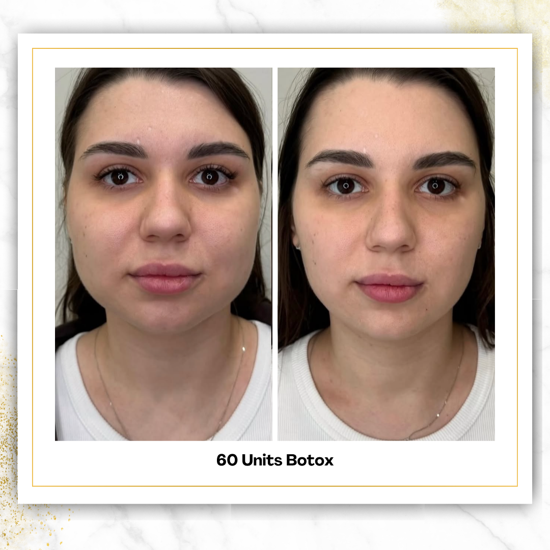 Botox ($6.85/unit)