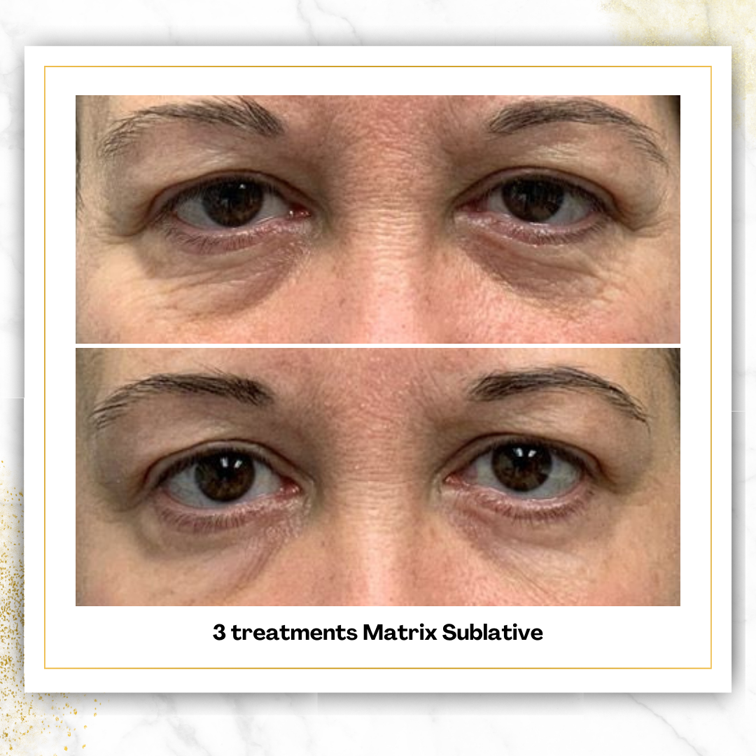Matrix Sublative For Under Eyes