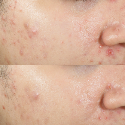 Epionce Purifying Spot Gel | Sulfur Spot Treatment