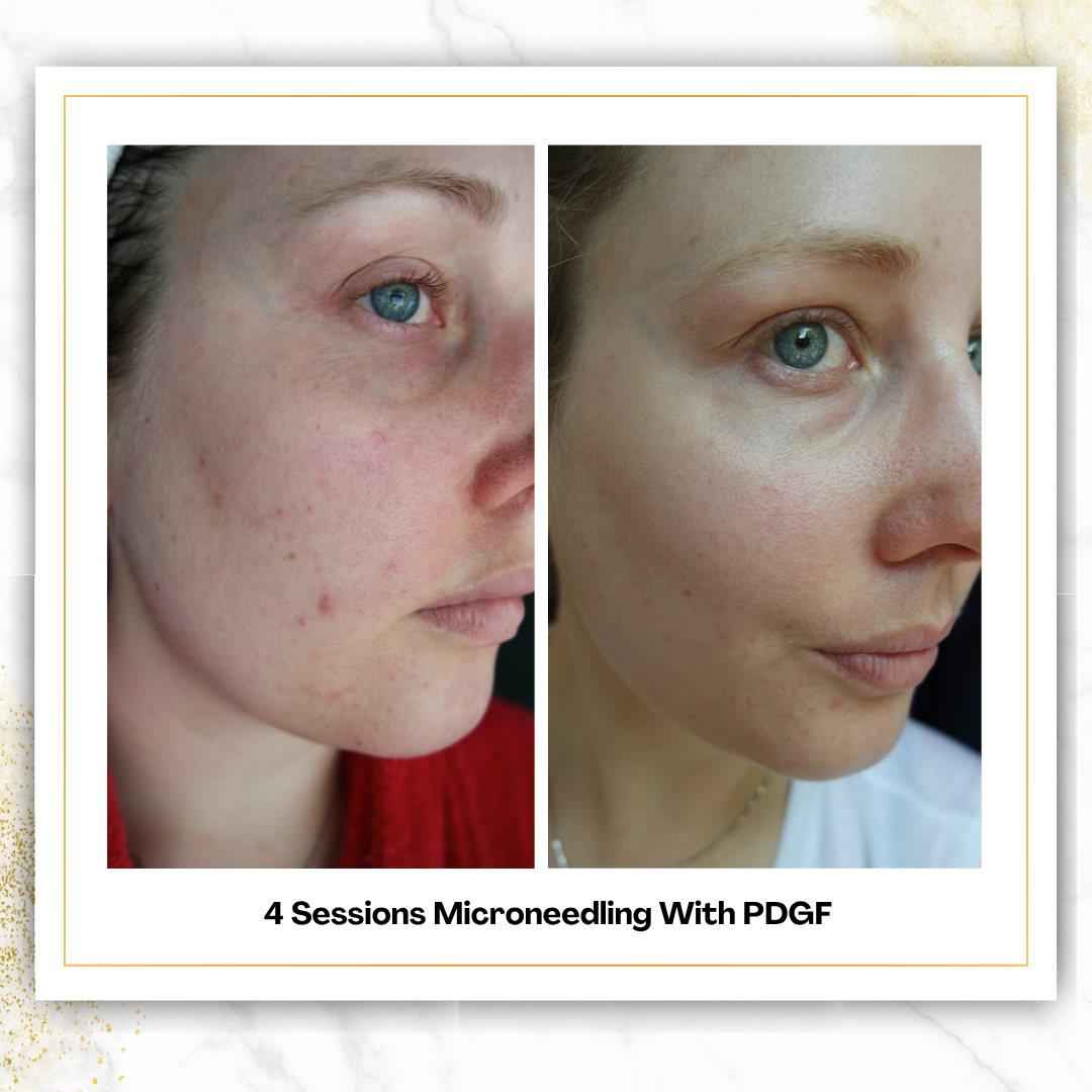 Microneedling With PDGF