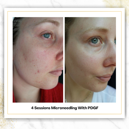 Microneedling With PDGF